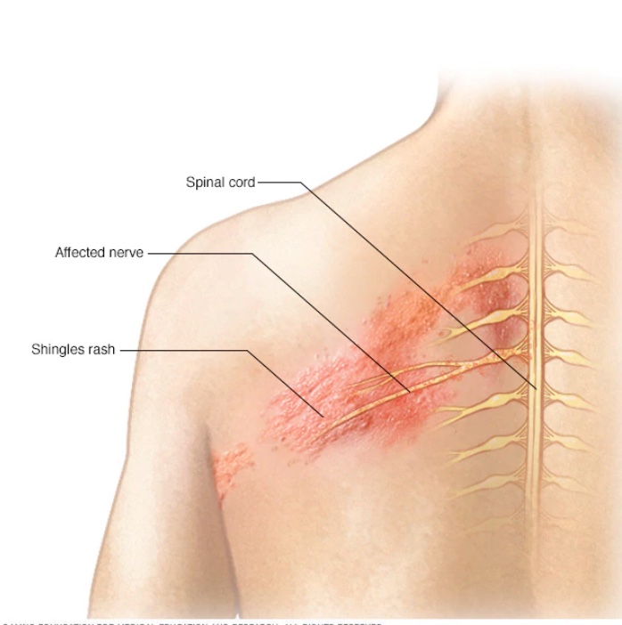 Health and Wellness Should You Get the Shingles the Vaccine?